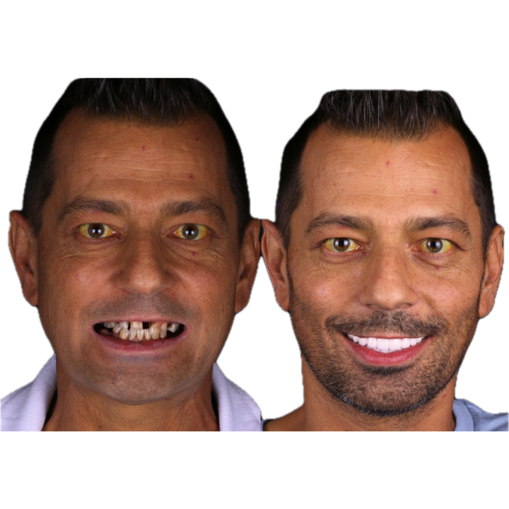 Before and after photos showing a man with missing teeth, then smiling with a full set of white teeth.