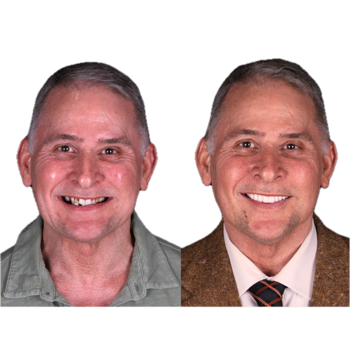 Side-by-side dental before-and-after of a man. The 