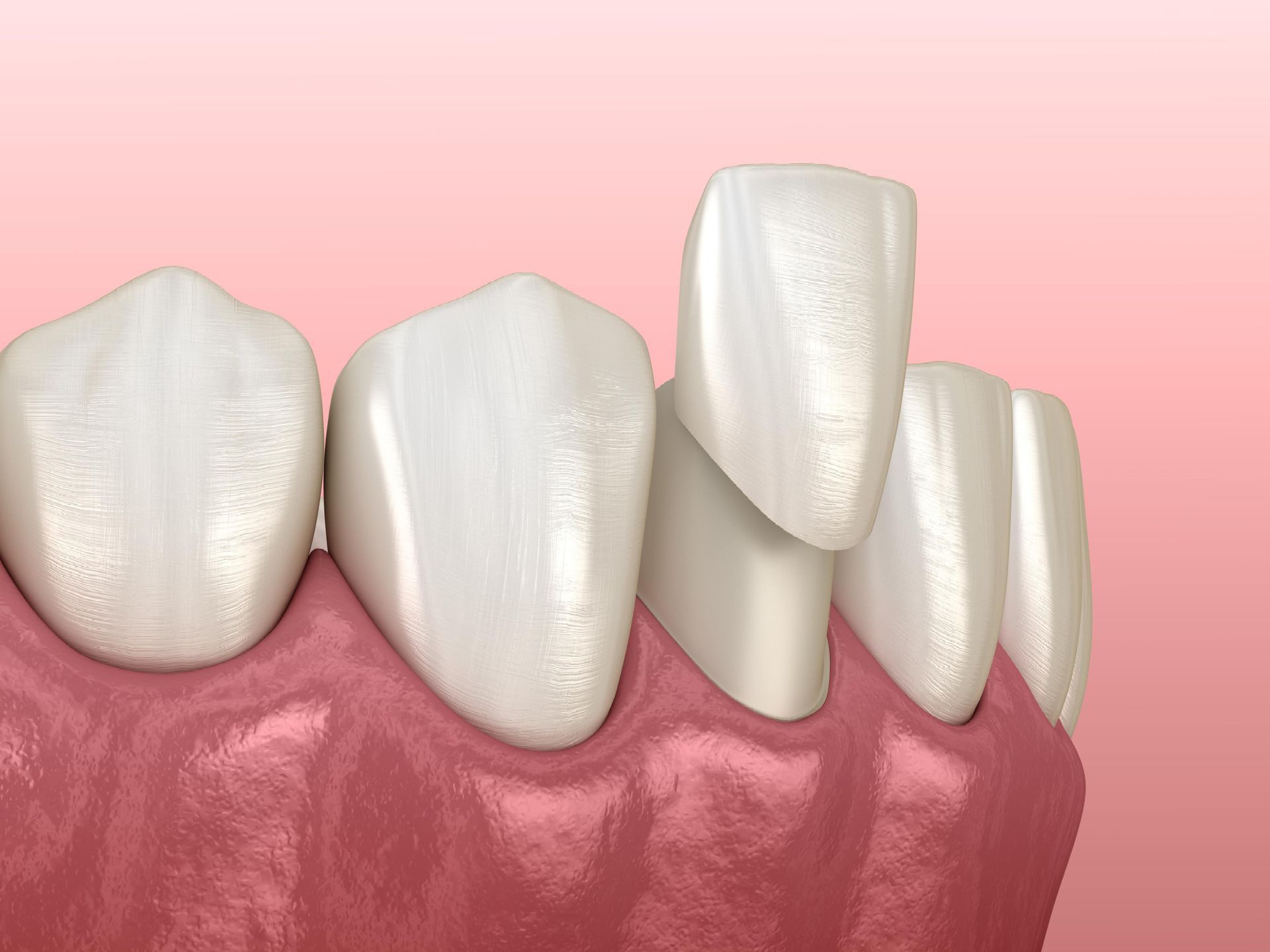 Close-up of teeth with a dental veneer partially placed, showing pink gums and light pink background.