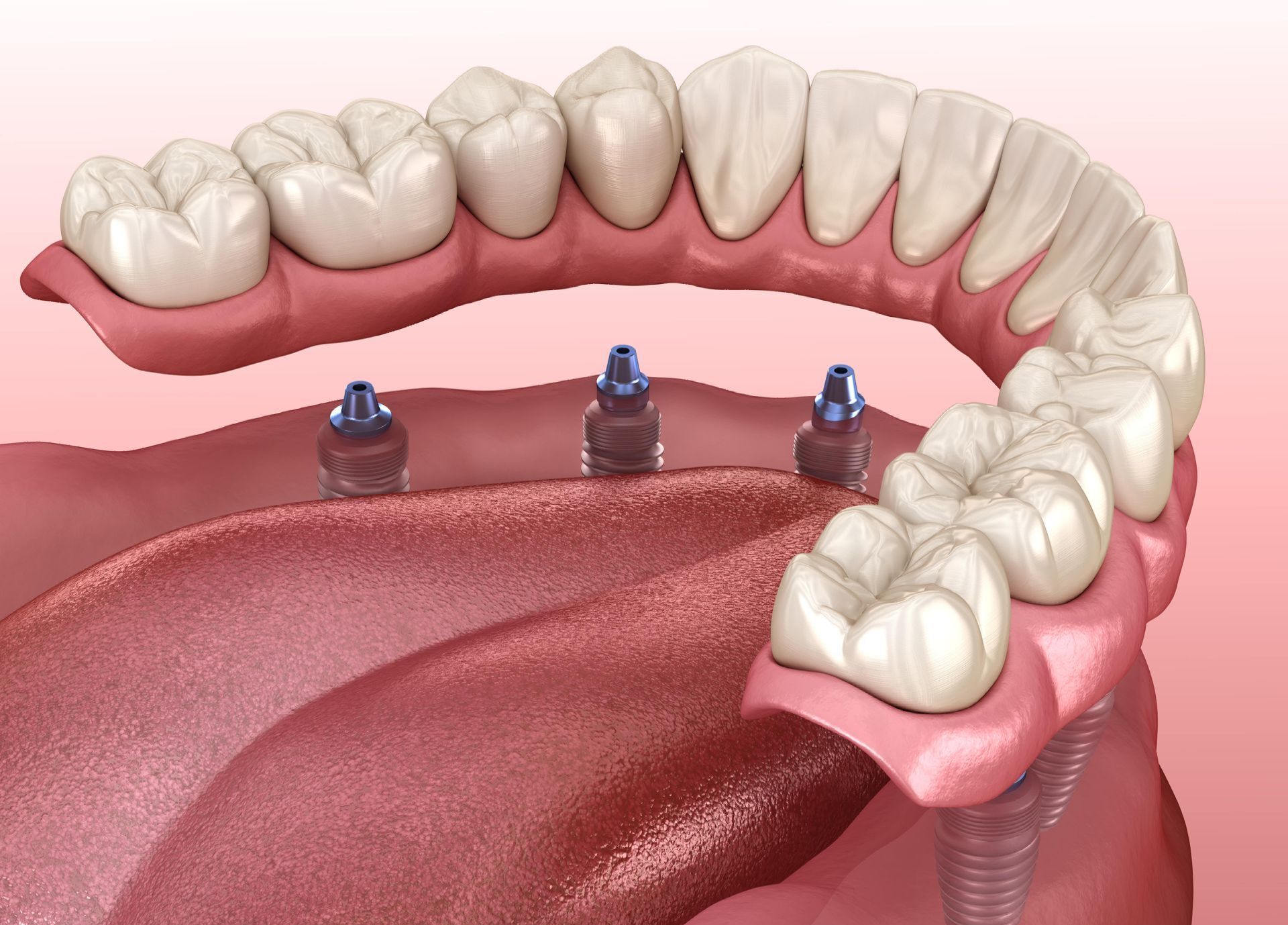 Dental illustration: dentures attached to three implants in the lower jaw.
