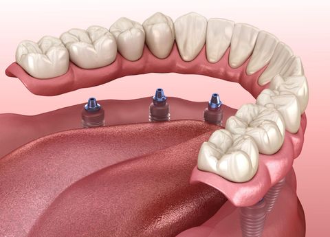 Dental illustration: dentures attached to three implants in the lower jaw.