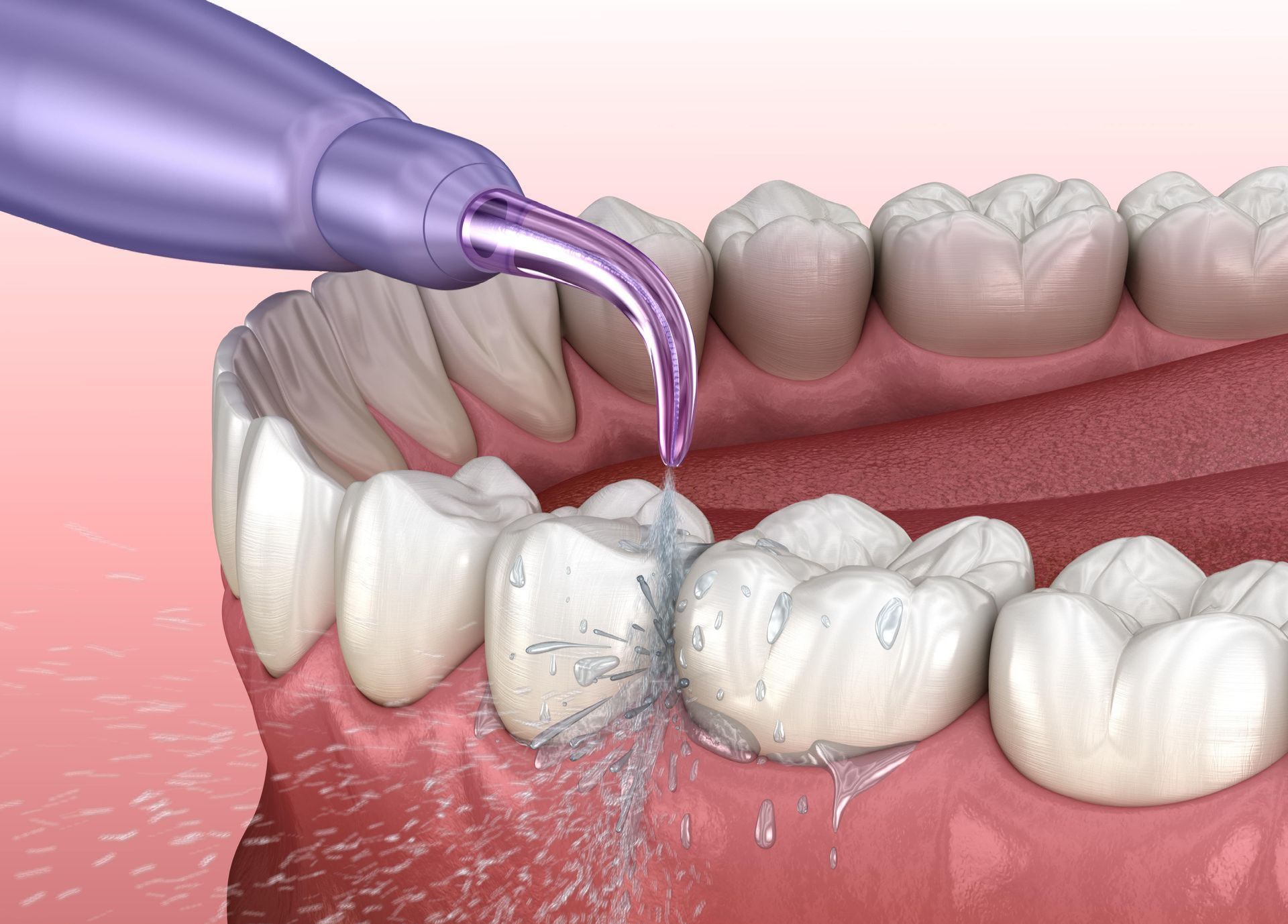 Dental hygienist cleaning teeth with water spray. Pink gums, white teeth, purple tool.