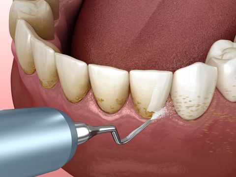 Dental cleaning: tool removing plaque from teeth in a mouth.