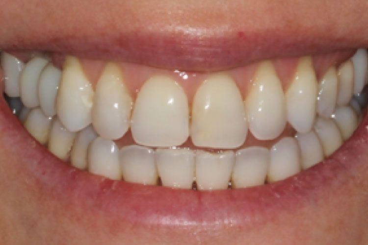 Close-up of a person's bright smile, revealing healthy white teeth and pink gums.
