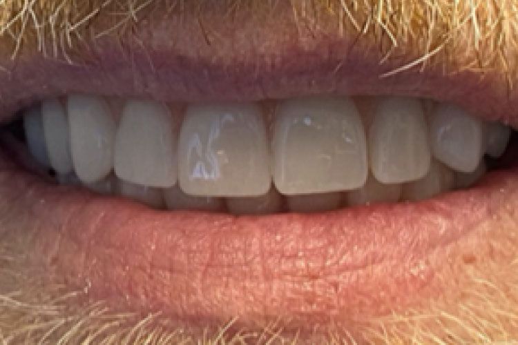 Close-up of a person's smiling mouth showing straight, white teeth. The lips are pink, and there is light stubble.