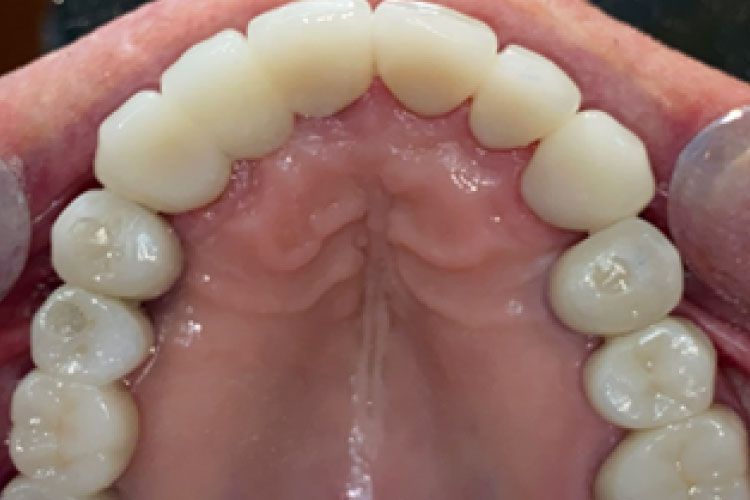 Overhead view of a person's upper teeth. The teeth are white and appear to be dental work. Pink gums.