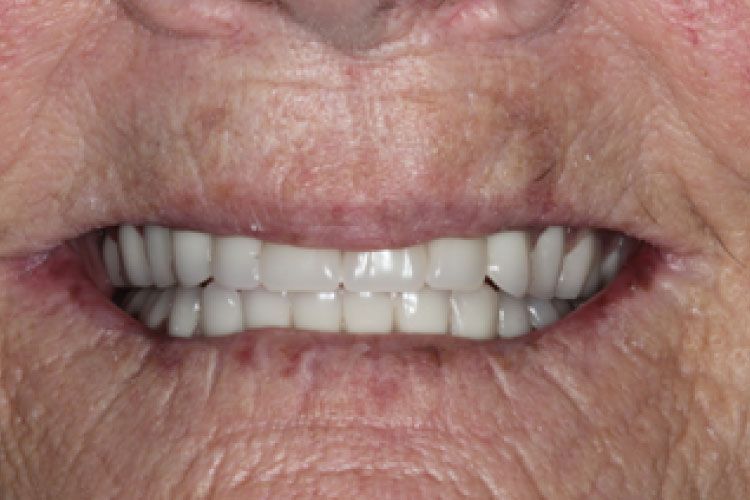 Close-up of a person's mouth with a full set of bright, white teeth and wrinkled skin around the mouth.