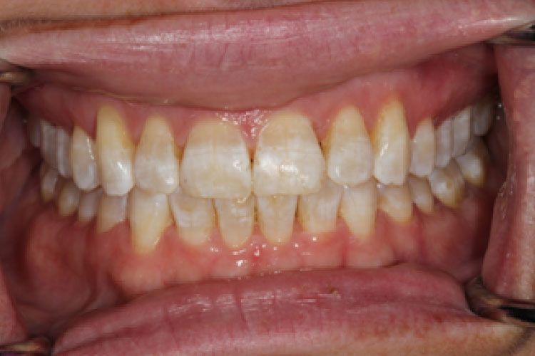 Close-up of a person's teeth, showing slight yellowing and normal alignment.