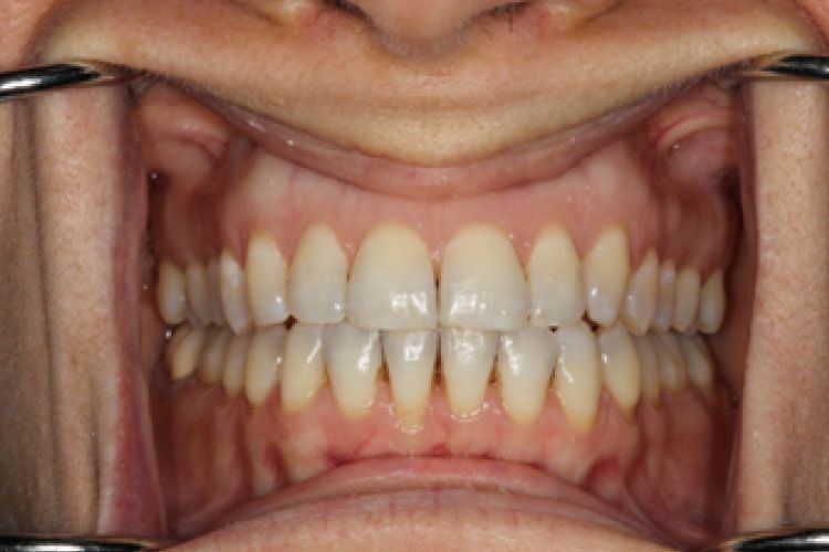 Mouth with healthy teeth, held open by cheek retractors. Pink gums, white teeth are visible in the mouth.