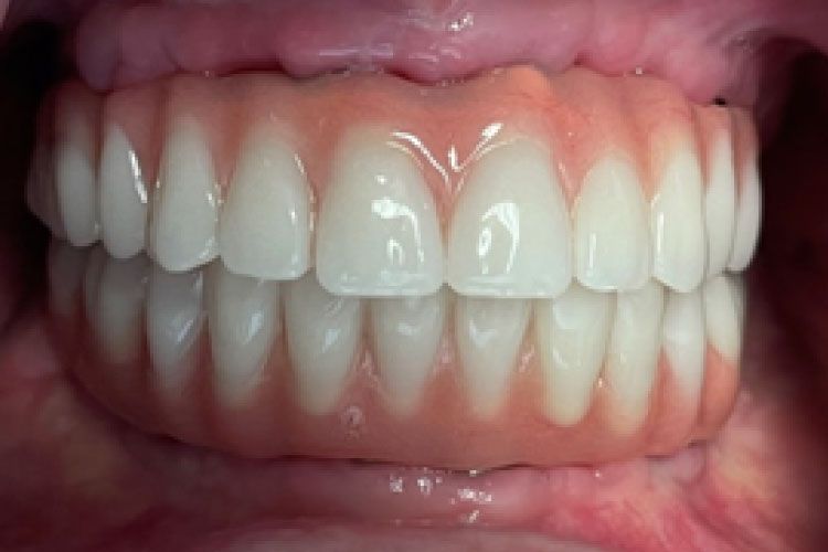 Close-up of a person's mouth displaying a full set of dentures, with white teeth set in pink gums.
