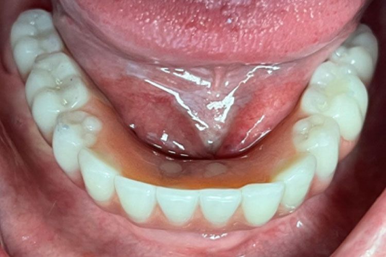 Interior view of an open mouth with a lower set of dentures; pink gums, white teeth.
