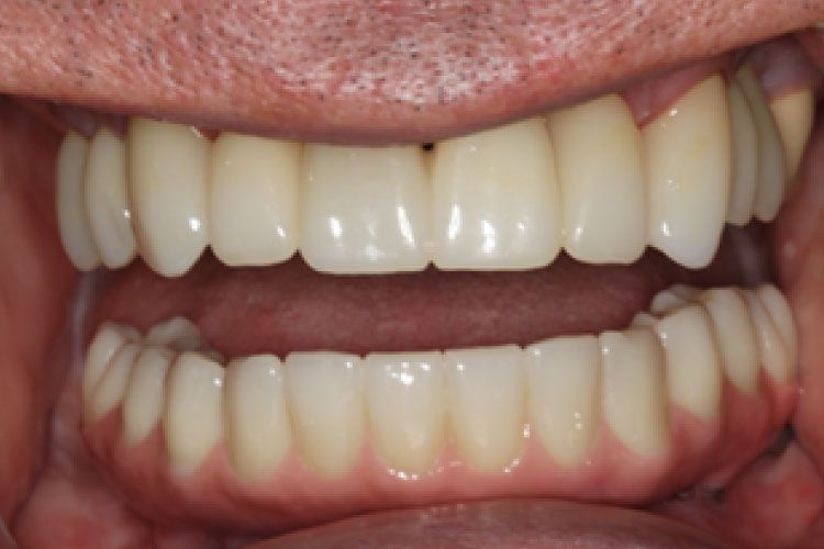 Open mouth, showing upper and lower complete dentures; artificial teeth are light-colored.