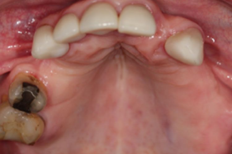 Interior view of the mouth showing upper teeth, palate, and a missing tooth. The adjacent tooth has a dark filling.