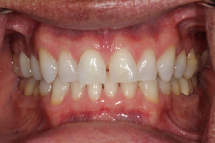 Close-up of a person's teeth. White teeth, pink gums, open mouth.