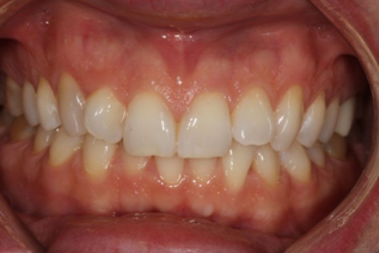 Close-up of a person's teeth. They are white with slightly yellow hues, in a neat, aligned row. The gums are pink.
