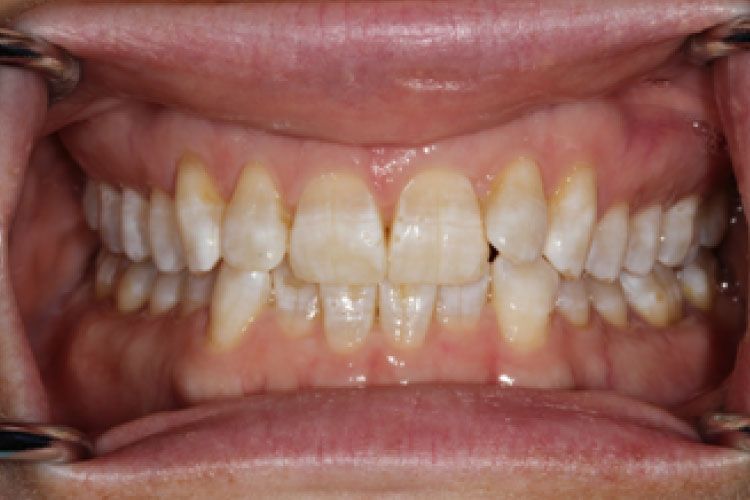 Close-up of teeth, slightly yellowed, with visible dental work, inside of an open mouth.