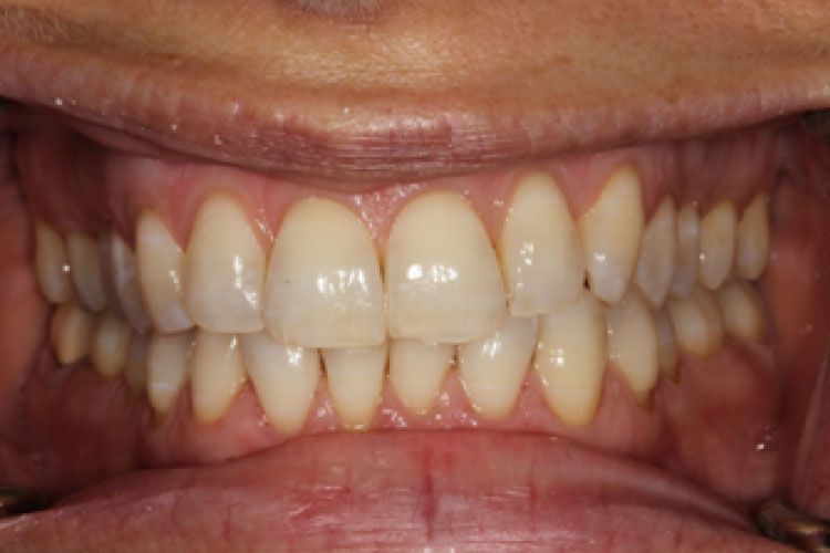Close-up of a person's teeth. White teeth, pink gums, visible upper and lower teeth rows.