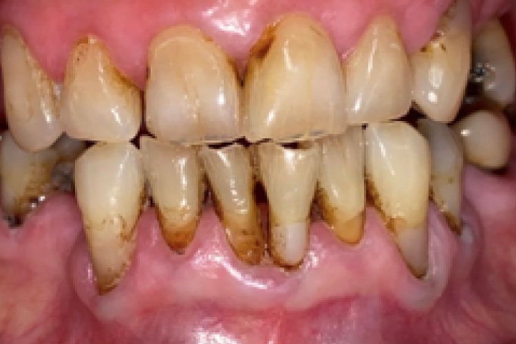 Close-up of human teeth showing significant plaque buildup and discoloration, suggesting poor oral hygiene.