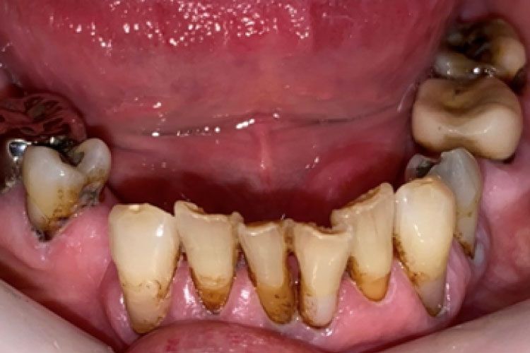 Close-up of a person's mouth showing teeth with significant plaque and discoloration. Gums are inflamed.