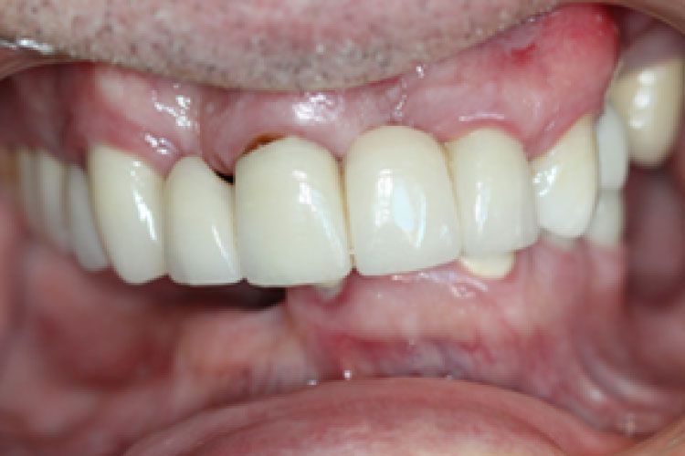 Close-up of a mouth with visible teeth. One tooth is missing, the others are white and healthy.