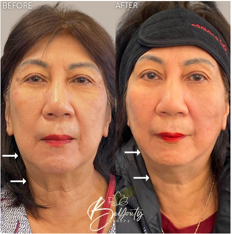 Before-and-after face comparison: left without headband, right with black headband; arrows point to jawline changes.