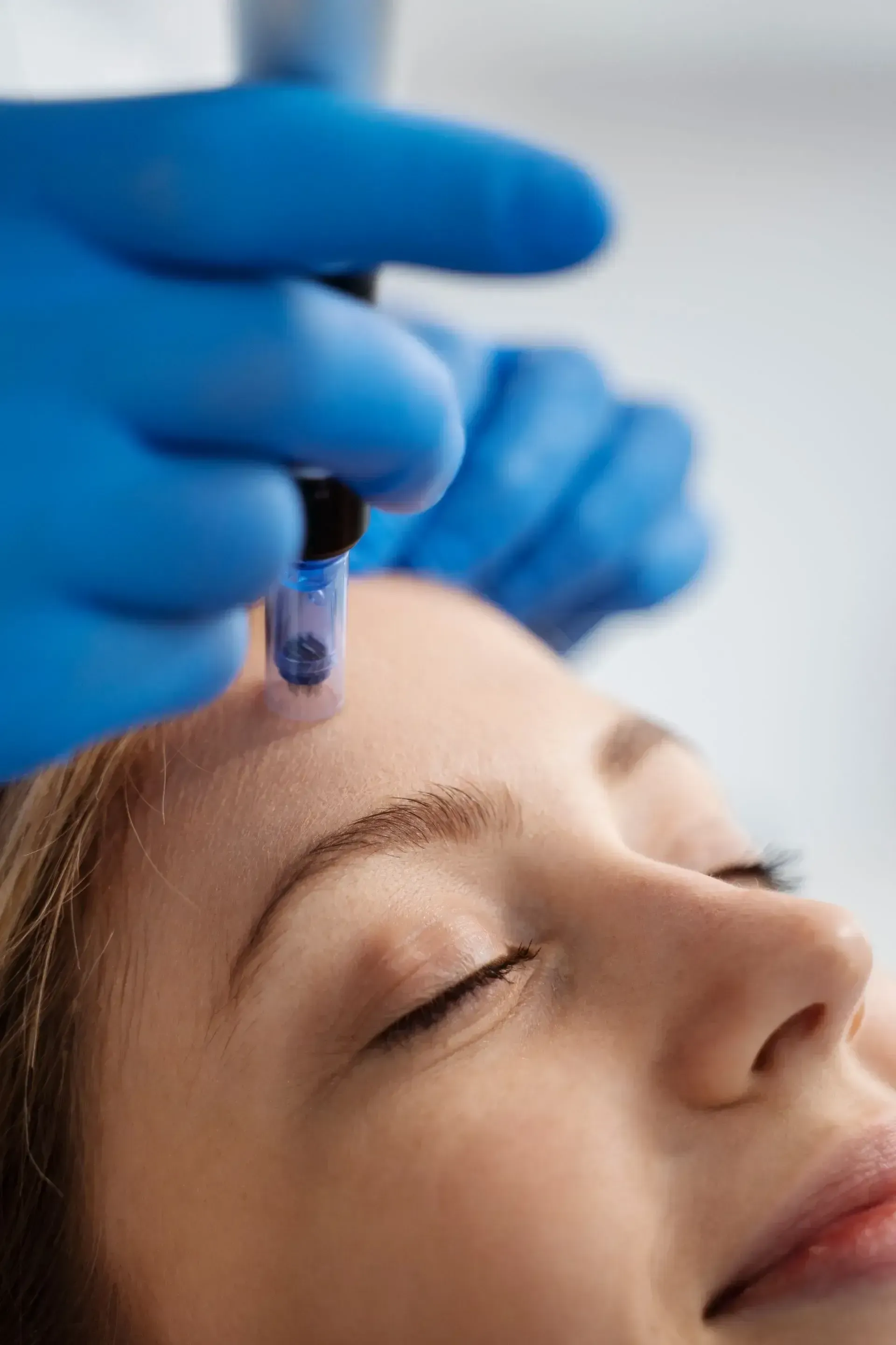 Gloved hand holding a microneedling device to a woman’s forehead during a facial treatment