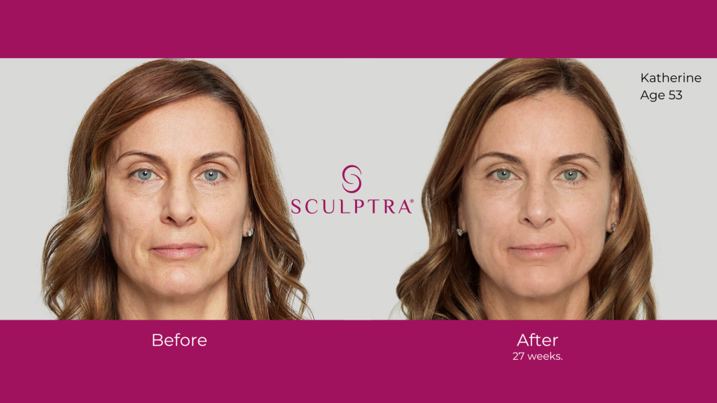 Before-and-after cosmetic treatment comparison showing a woman’s face with smoother skin and reduced wrinkles.