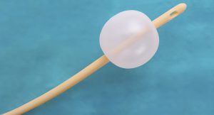 A Foley catheter, beige tube with an inflated, clear balloon, resting on a blue surface.