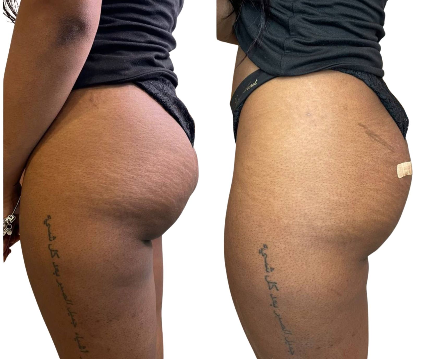 Side-by-side torso photos showing a person’s side profile before and after body contour changes.