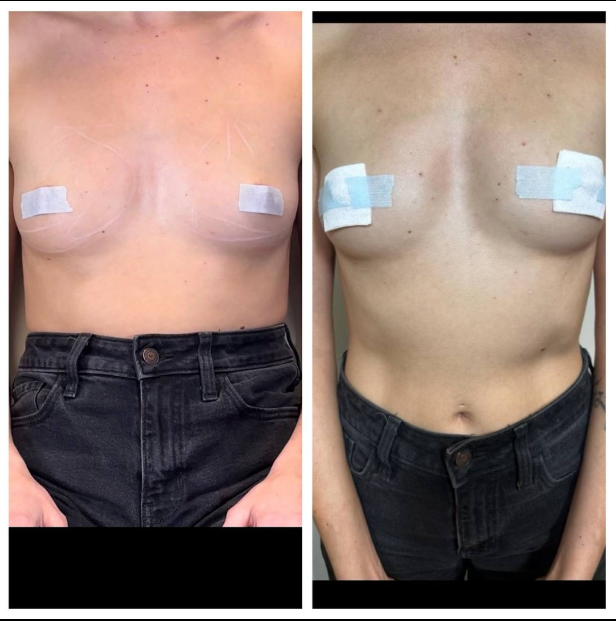 Side-by-side torso photos of a shirtless person with taped nipples, showing before and after body contouring.