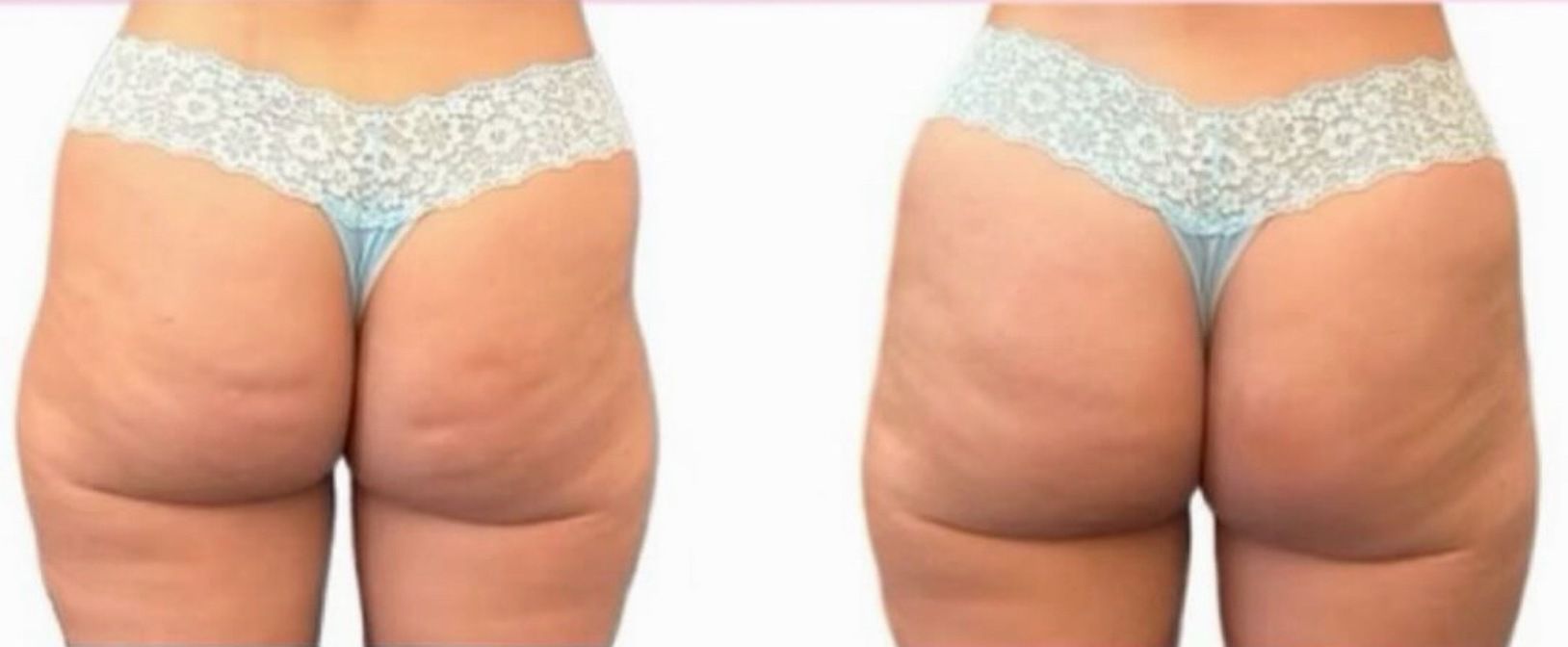 Side-by-side before-and-after view of a person wearing white underwear, showing smoother skin on the right