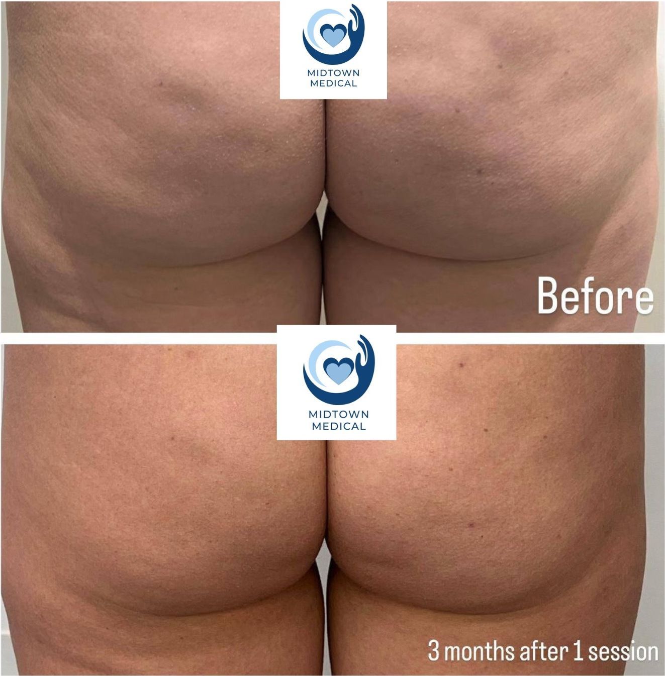 Before-and-after close-up of skin: smoother texture after 3 months and 1 session.