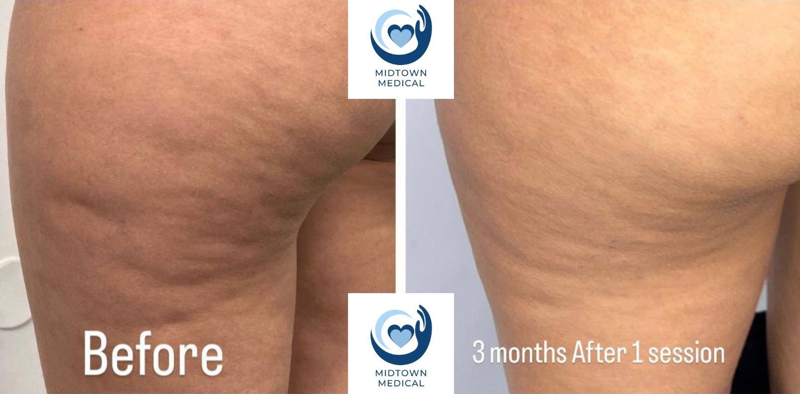 Before-and-after side view of skin with reduced cellulite, labeled “Before” and “3 months after 1 session.”
