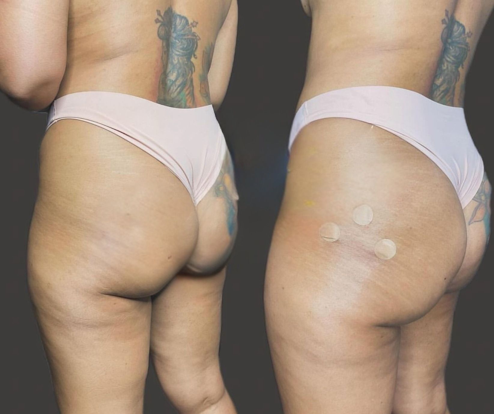 Side-by-side back view of a person in pink underwear showing a fuller hip and thigh contour after treatment