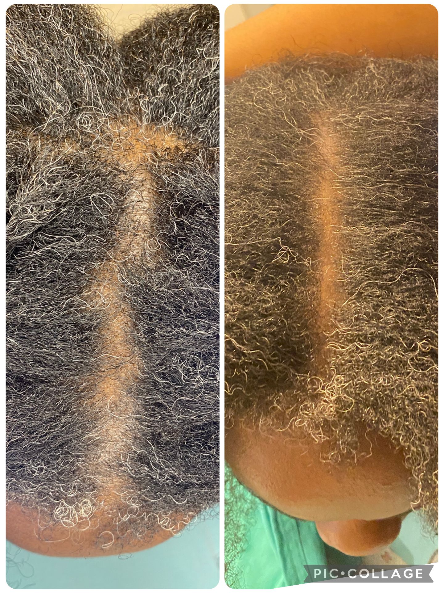 Side-by-side close-up scalp photos showing a central parted line with visible hair thinning.