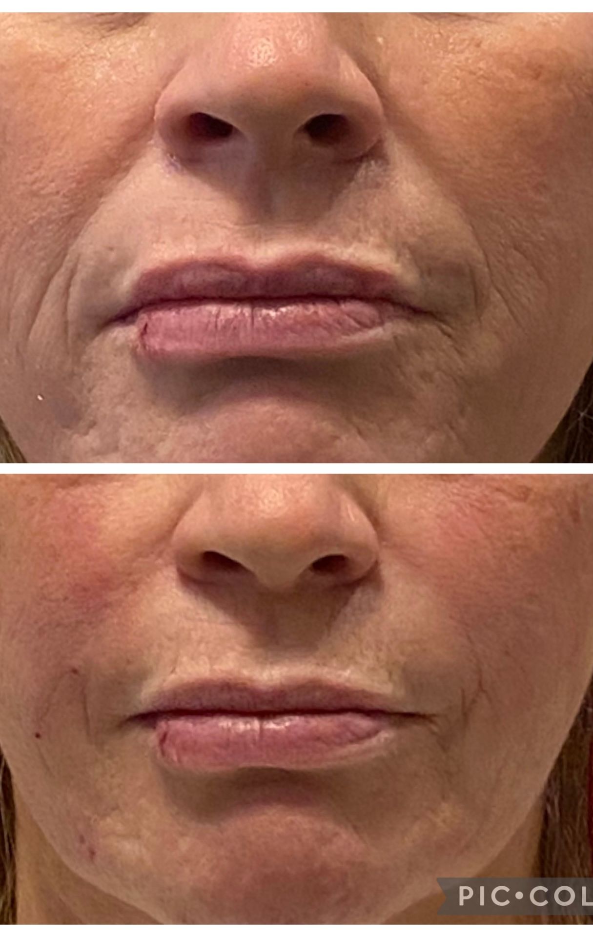 Close-up comparison of lower face, showing before-and-after mouth wrinkles and lip appearance.