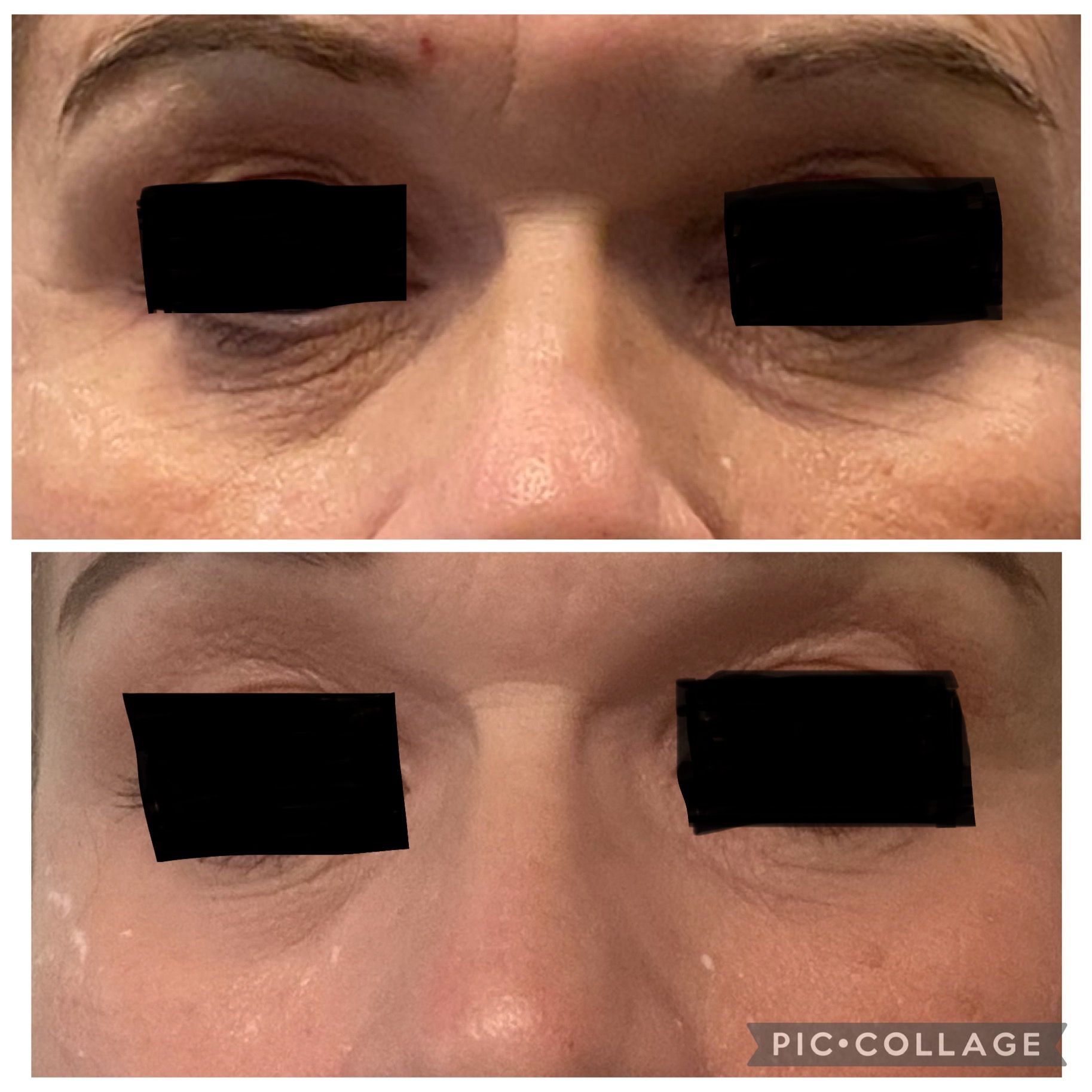 Close-up of a person’s eyes in two side-by-side photos, with the eyelids appearing different in each.