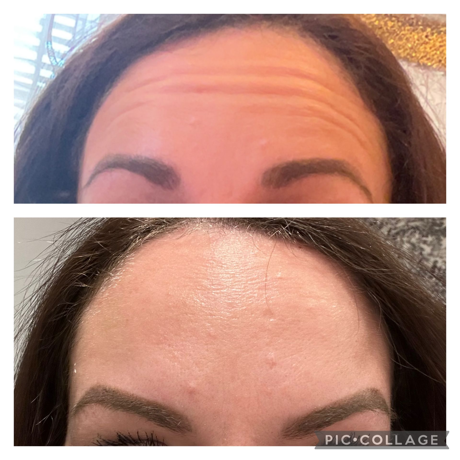 Top and bottom close-ups of a forehead showing before-and-after skin texture improvement.