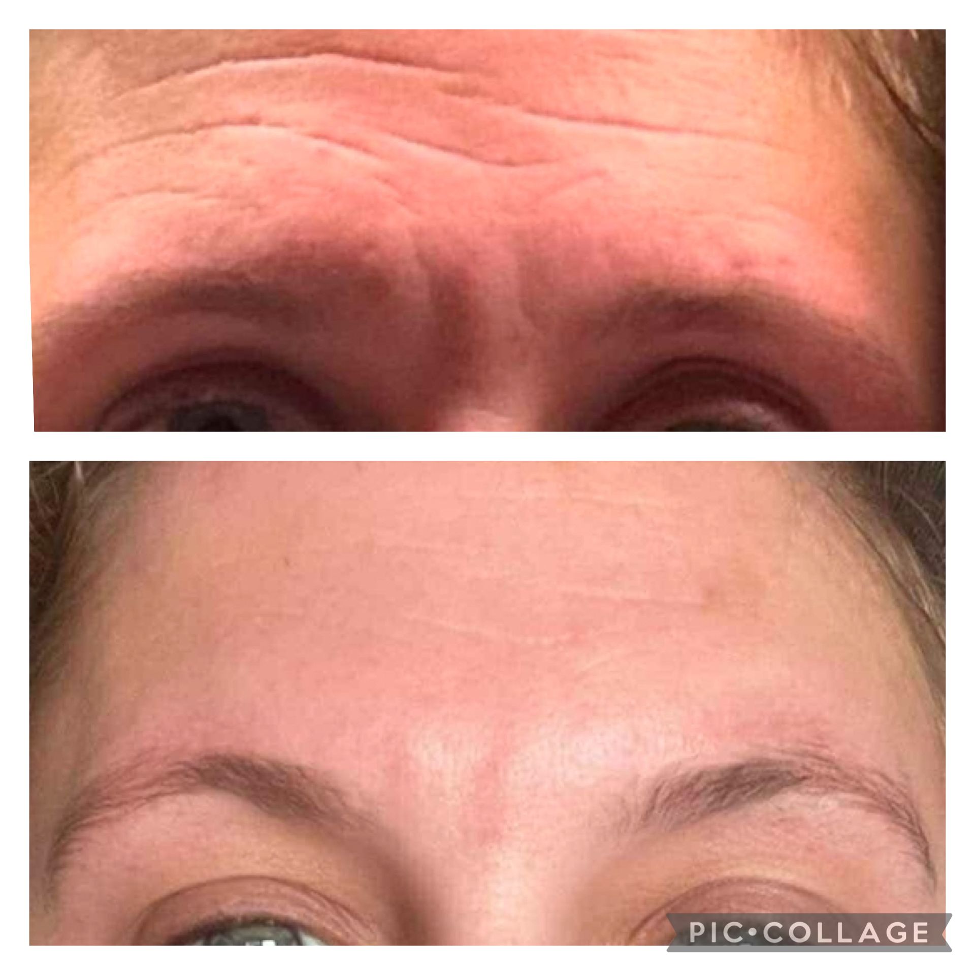 Close-up of a forehead before and after smoothing, shown in a side-by-side comparison.