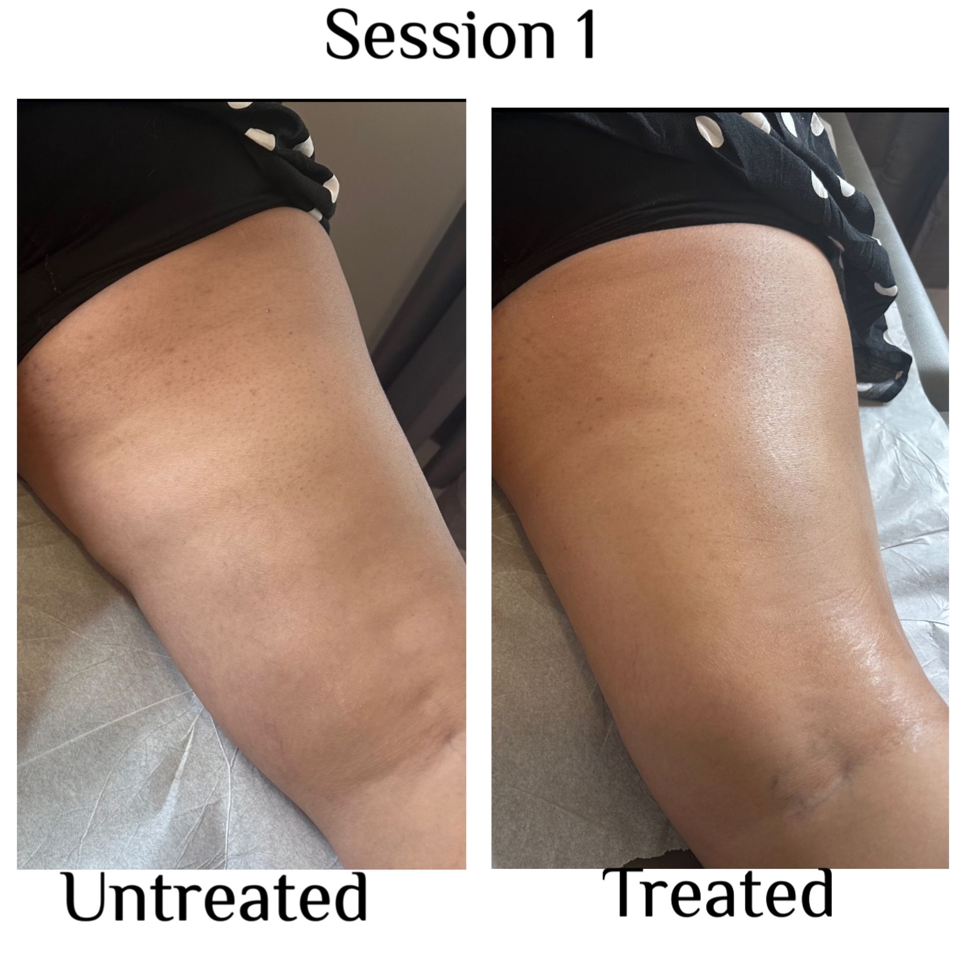 Side-by-side thigh photos labeled Untreated and Treated under Session 1.