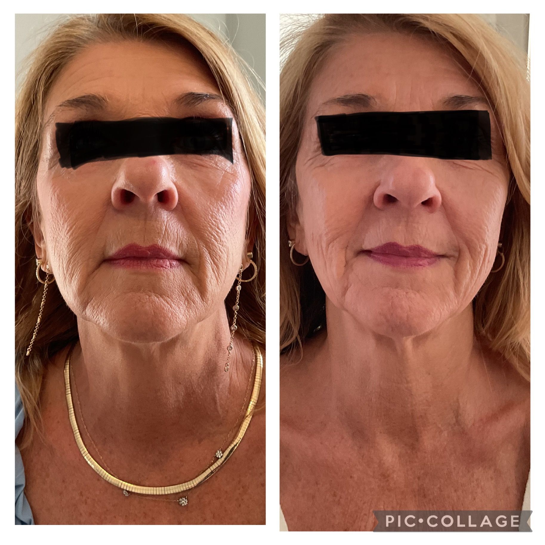 Side-by-side portraits of a woman with black bars over her eyes, showing before-and-after facial changes.