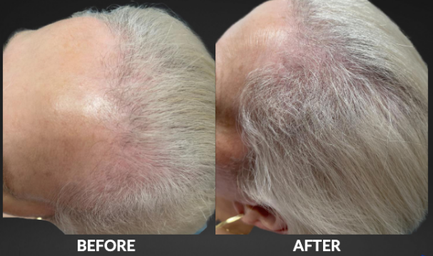 Side-by-side scalp photos labeled before and after, showing increased hair coverage on the crown.