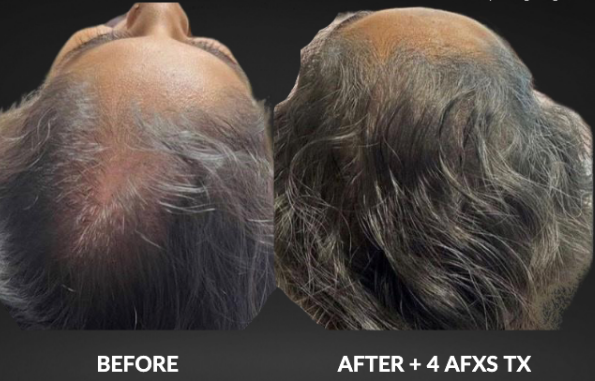 Top of head before and after hair treatment, showing fuller hair after 4 AFXS sessions