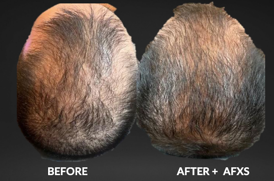 Side-by-side scalp photos labeled “Before” and “After + AFXS,” showing improved hair growth.