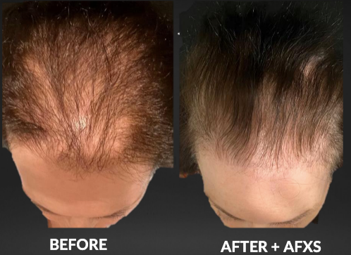 Side-by-side scalp photos labeled before and after AFXS, showing more hair coverage after treatment