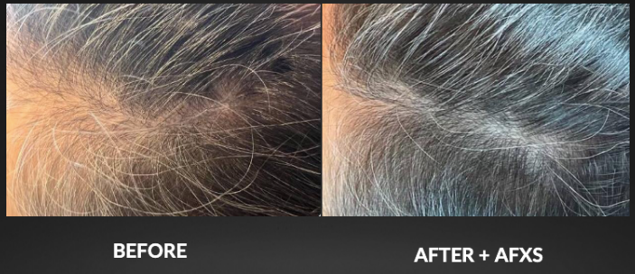 Scalp close-up before and after AFXS, showing reduced thinning and more visible hair coverage.