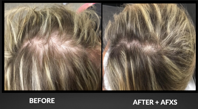 Side-by-side close-up of scalp before and after AFXS, showing fuller hair coverage and less visible scalp