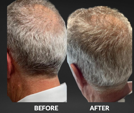 Side-by-side before and after photos of the back of a man's gray hair, showing fuller coverage after