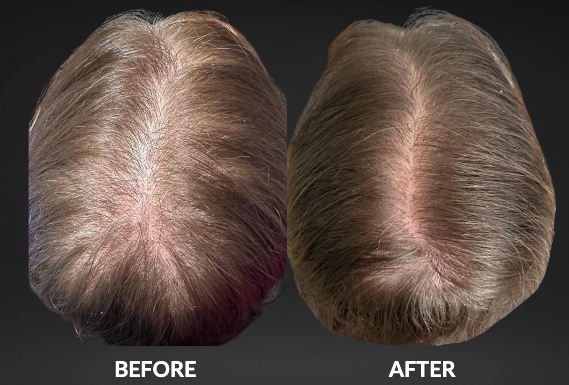 Top-view before-and-after scalp showing fuller hair coverage after treatment