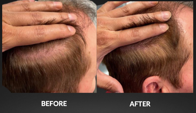Before-and-after close-up of a scalp showing hair thinning improved after treatment.